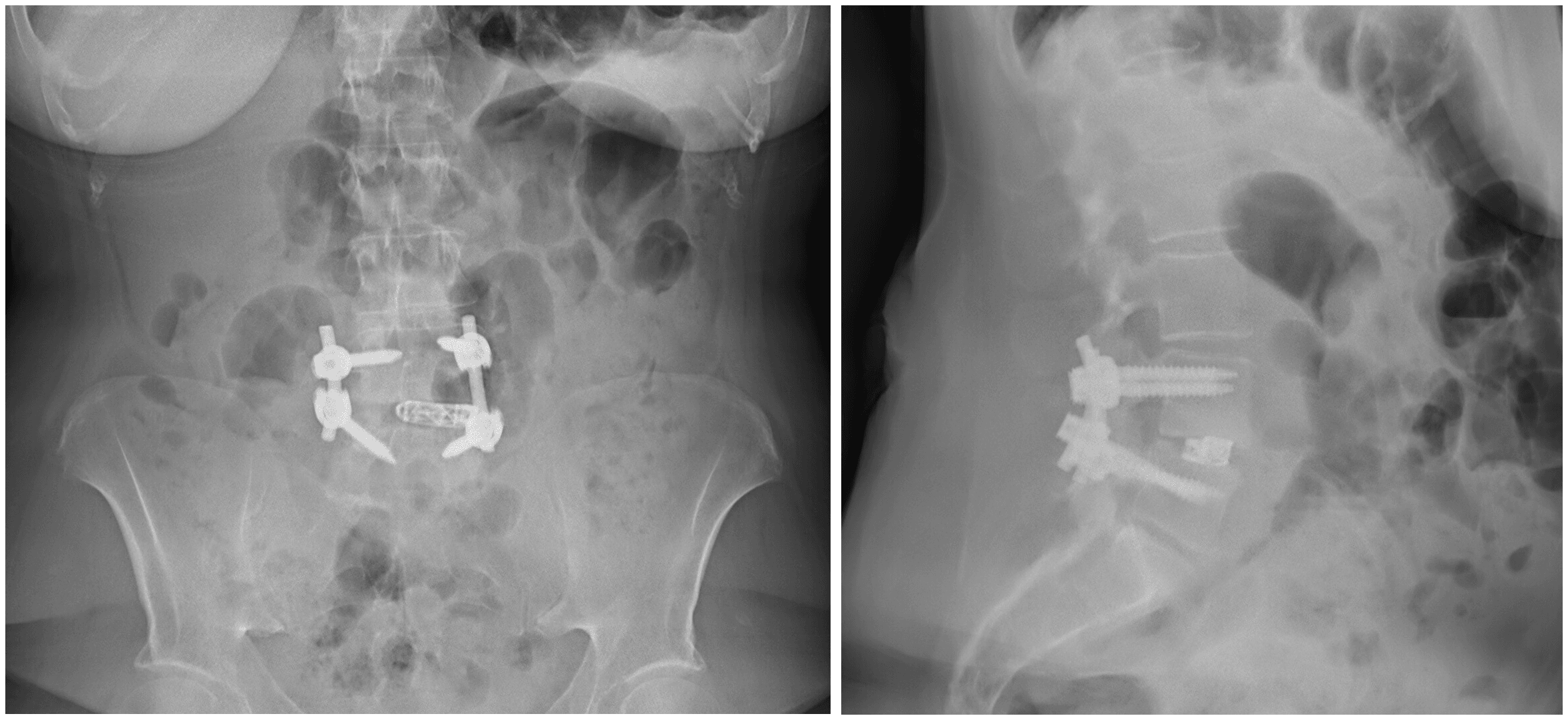 AP and lateral radiographs of a transforaminal lumbar interbody fusion.