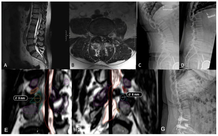 Lumbar MRI flexion-extension radiographs and axial corridor measurements used to select a TLIF route