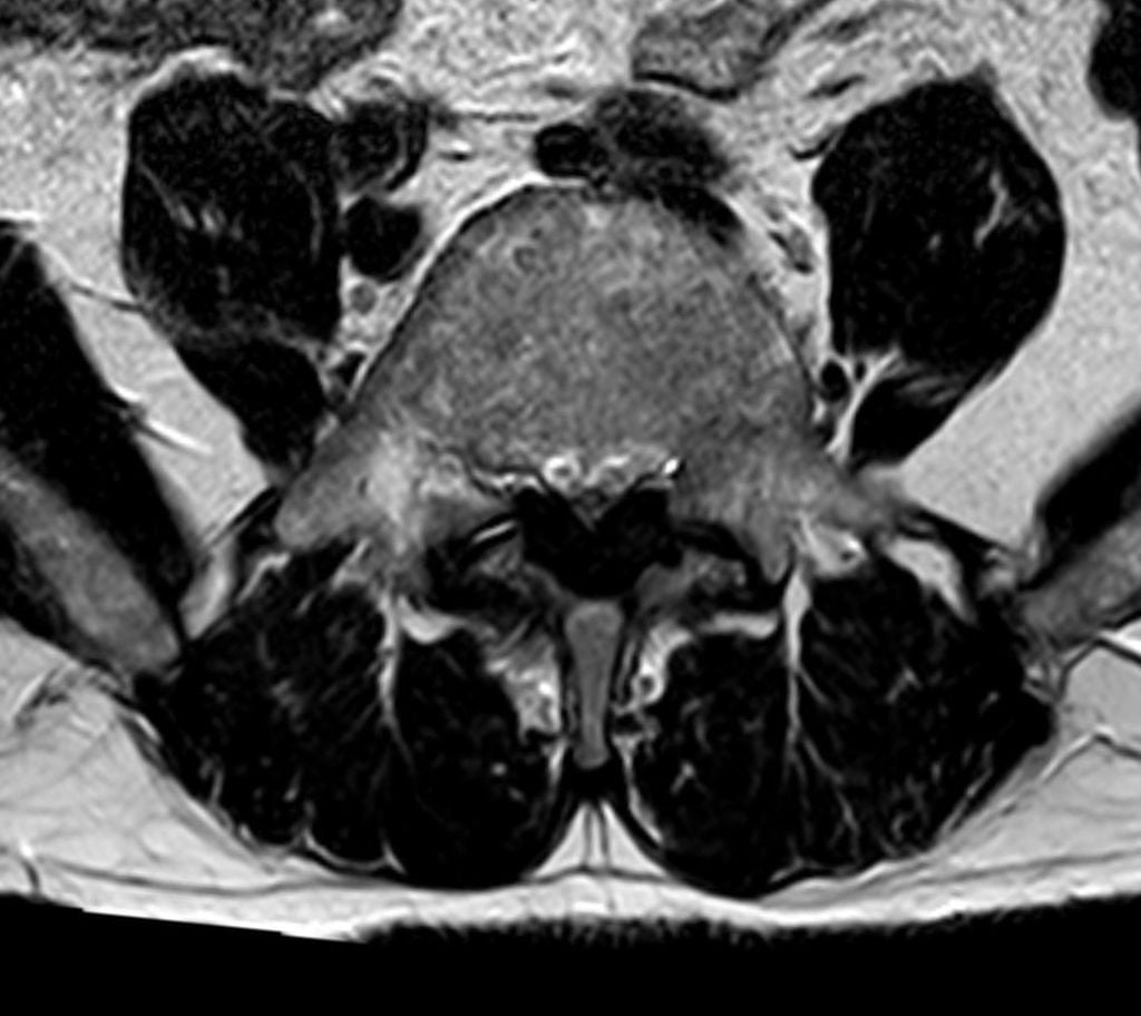 Axial T2-weighted lumbar MRI showing severe central canal stenosis at L5 from ligamentum flavum hypertrophy and facet arthrosis.