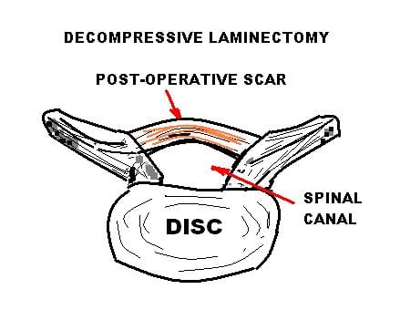 Line drawing of a lumbar vertebra after decompressive laminectomy, showing the widened spinal canal and post-operative epidural scar.