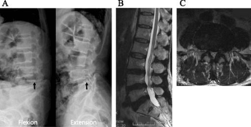 Flexion and extension lumbar radiographs with sagittal MRI showing degenerative L4-L5 spondylolisthesis and stenosis.