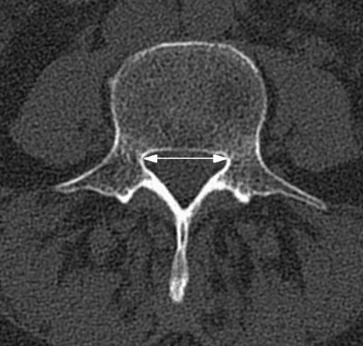 Axial CT at L4 with a white arrow marking the transverse diameter of the osseous lumbar spinal canal.