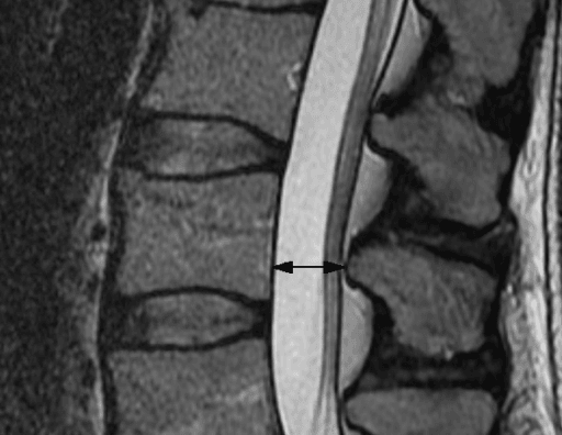 Sagittal T2 MRI with a black arrow marking the anteroposterior diameter of the osseous lumbar spinal canal.