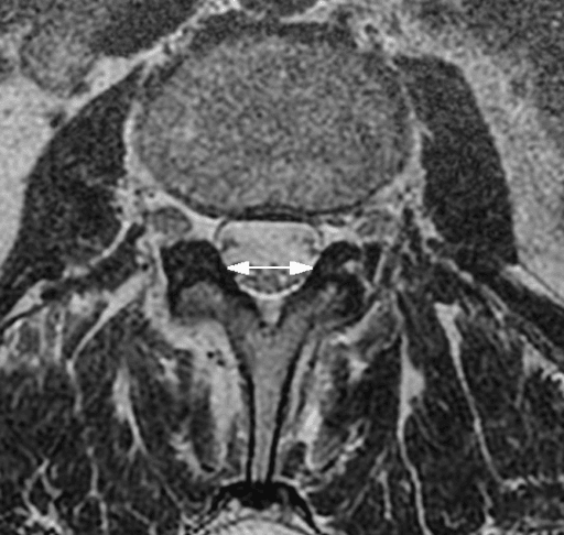 Axial T2 MRI at L3 with a white arrow marking the ligamentous interfacet distance.