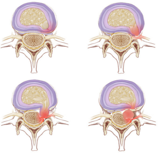 Four-panel axial cross-sectional diagram showing progression from a normal disc to increasing posterolateral disc herniation compressing the traversing nerve root.