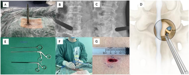 Composite showing interlaminar incision, fluoroscopic targeting, instruments and a schematic of lumbar endoscopic access.