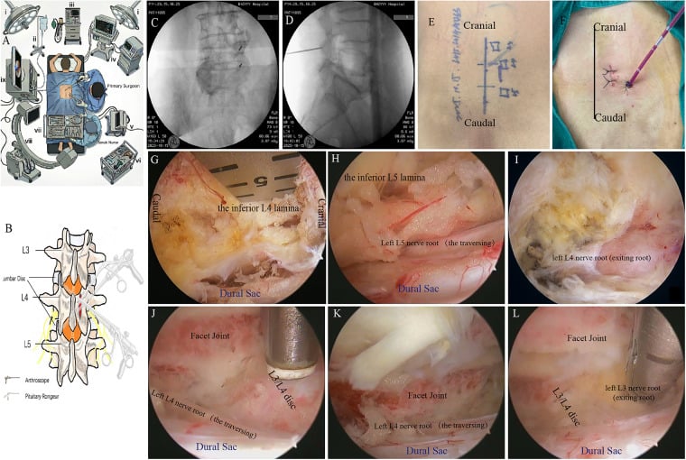 Composite schematic and endoscopic views showing the lumbar laminae, facet joints, dural sac, traversing nerve root and exiting nerve root.