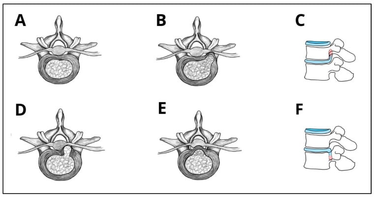 Six-panel axial and sagittal schematic showing normal anatomy, foraminal, paracentral and central lumbar disc herniation and cranial or caudal fragment migration.