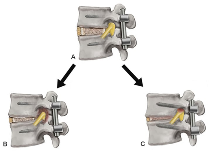Three-panel schematic showing progressive foraminal narrowing and exiting nerve-root compression after loss of disc height and segmental change.