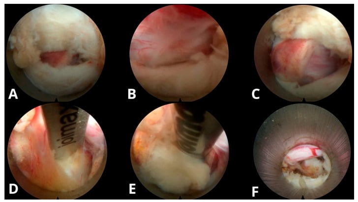 Six endoscopic views showing flavotomy, neural-element identification, disc-fragment exposure and removal during interlaminar lumbar discectomy.