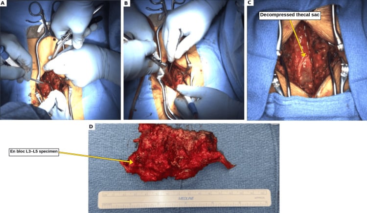 Operative photographs showing Kerrison decompression of the lateral recess and foramina, protected neural elements and the removed lamina specimen.