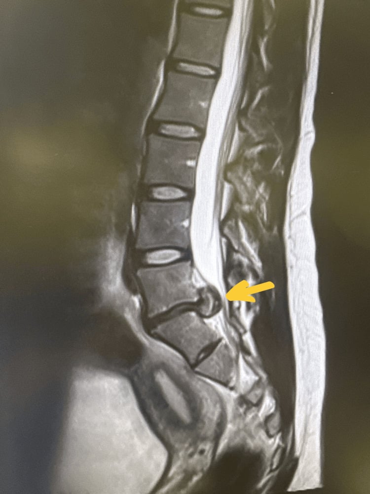 Sequential sagittal T2 lumbar MRI showing a massive central L5-S1 disc extrusion with cranio-caudal migration and severe cauda-equina compression.
