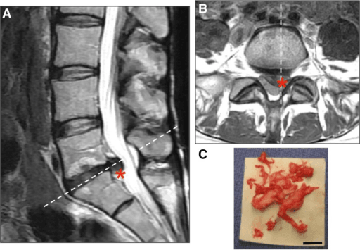 Sagittal and axial lumbar MRI showing a posterior disc herniation, with a photograph of excised disc material