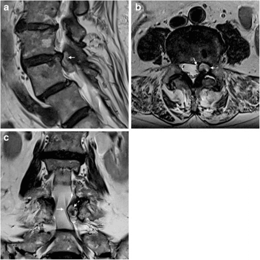 Three-panel MRI series showing a lumbar facet synovial cyst causing radiculopathy