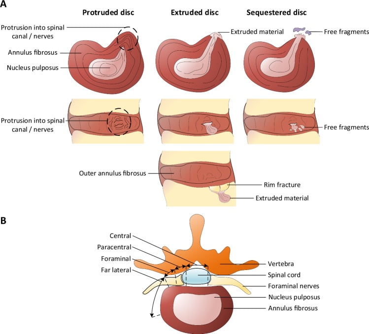 Axial and sagittal schematics comparing protruded, extruded and sequestered lumbar disc herniations and central, paracentral, foraminal and far-lateral zones.