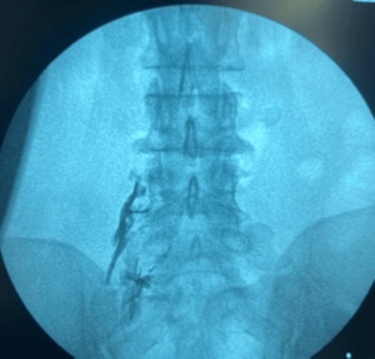 AP fluoroscopic image showing contrast outlining a lumbar nerve root after transforaminal needle placement.