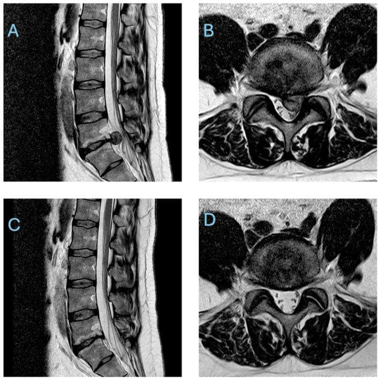 Sagittal and axial T2 lumbar MRI before and after five months of conservative treatment showing marked resorption of a large extruded disc.
