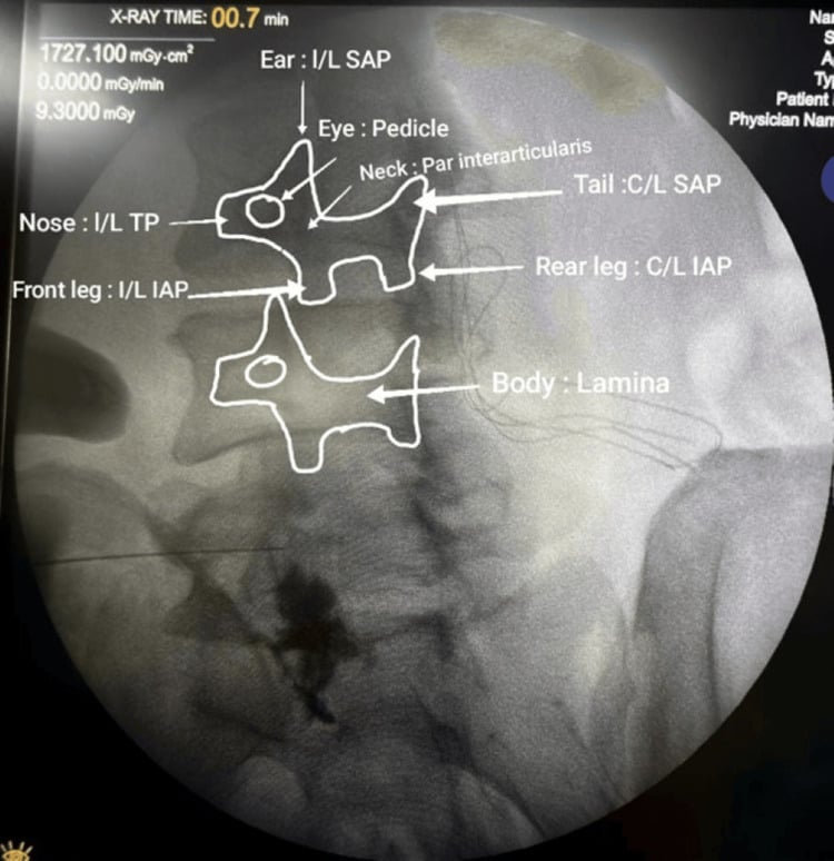 Oblique lumbar fluoroscopic image annotated with the Scottie-dog landmarks and a transforaminal needle target near the pedicle.