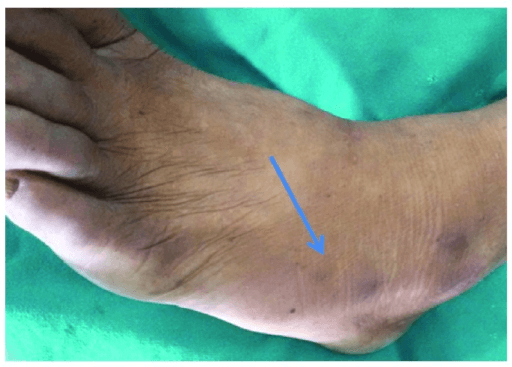 Extensor digitorum brevis muscle wasting in chronic lumbar stenosis