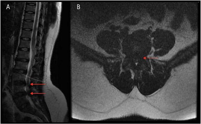 Sagittal and axial T2 MRI showing central and lateral-recess lumbar stenosis at L3-L4 and L4-L5, worst at L4-L5