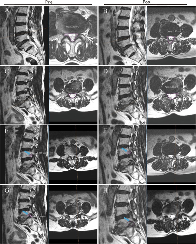 Paired sagittal and axial lumbar MRI before and after two-level decompression, central canal and foraminal areas traced with printed values in most panels