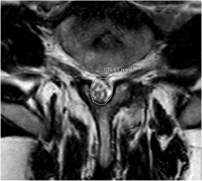 Axial T2 lumbar MRI with the dural sac cross-sectional area outlined and printed as 106.63 square millimetres