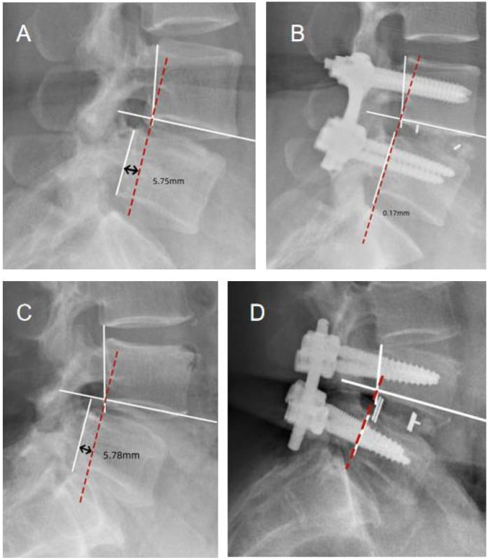 Lateral lumbar radiographs marked up for L4-L5 translational measurement, two without instrumentation printing 5.75mm and 5.78mm, one instrumented printing 0.17mm and one instrumented with lines drawn but no printed value