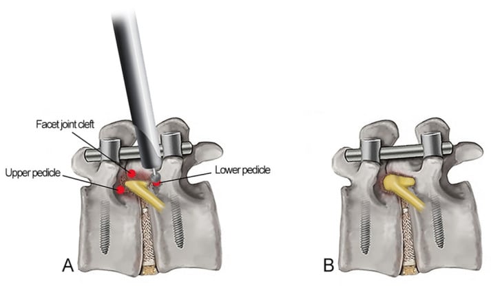Schematic of transforaminal endoscopic foraminotomy at an instrumented segment, red dots on the labelled landmarks of lower pedicle, facet joint cleft and upper pedicle around the exiting root