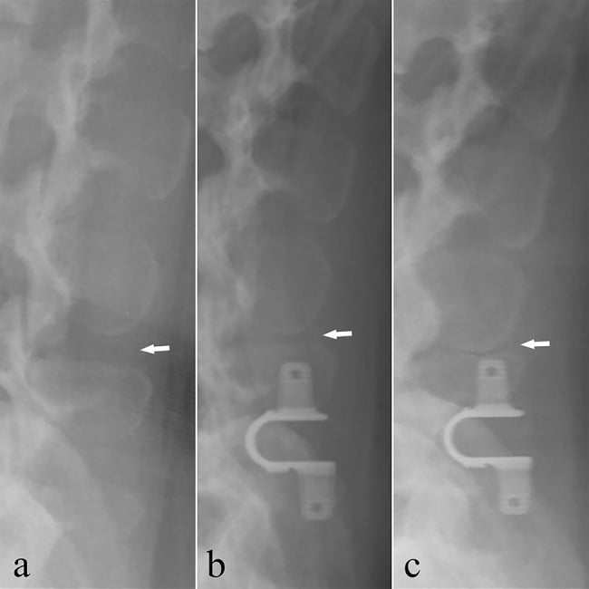 Serial lateral lumbar radiographs of one patient before and after interspinous device implantation, arrows marking the adjacent spinous processes gradually approaching each other