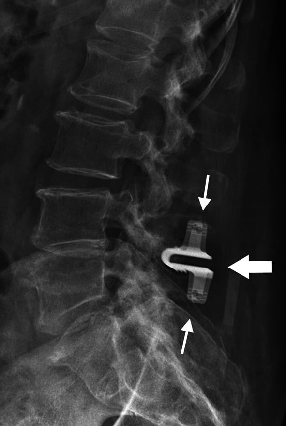 Lateral lumbar radiograph of a U-shaped interspinous spacer between the L4 and L5 spinous processes, thick arrow on the device and thin arrows on the crimped keels