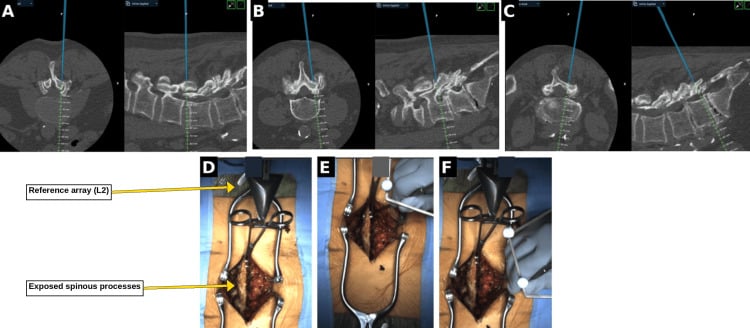 Navigation screenshots of planned bilateral laminectomy troughs at L3, L4 and L5, and operative photographs of the exposed spinous processes with a labelled reference array