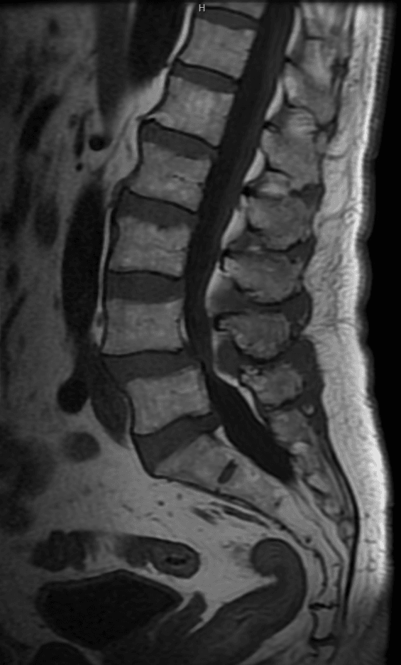 Sagittal T2 MRI of degenerative lumbar spinal stenosis at L4-L5 with grade I anterolisthesis