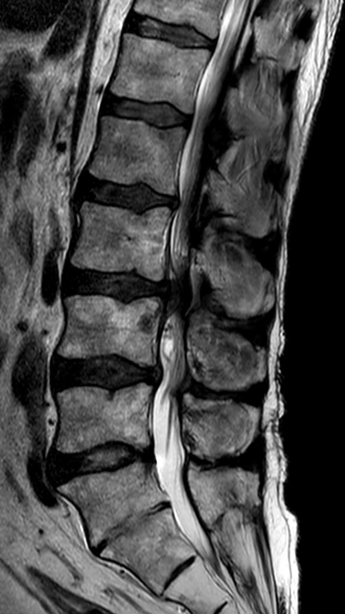 Sagittal T2 MRI showing redundant cauda equina nerve roots above a lumbar canal stenosis