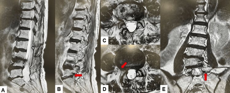 Midsagittal, left parasagittal, axial and coronal T2 MRI of one patient, red arrows marking left L5-S1 foraminal stenosis