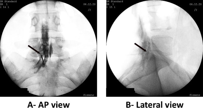 Fluoroscopy in AP and lateral views of a parasagittal interlaminar epidural injection, arrows on the needle tip with contrast in the epidural space