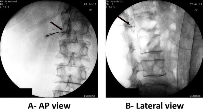 Fluoroscopy in AP and lateral views of a transforaminal epidural injection, arrows on the needle tip at the foramen with contrast outlining the epidural space