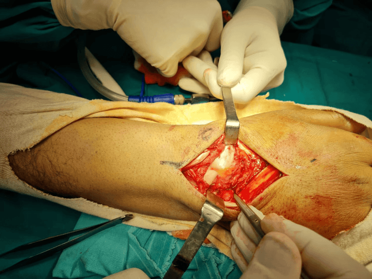 Intraoperative dorsal wrist exposure held open with retractors, with the carpus seen through the opened capsule