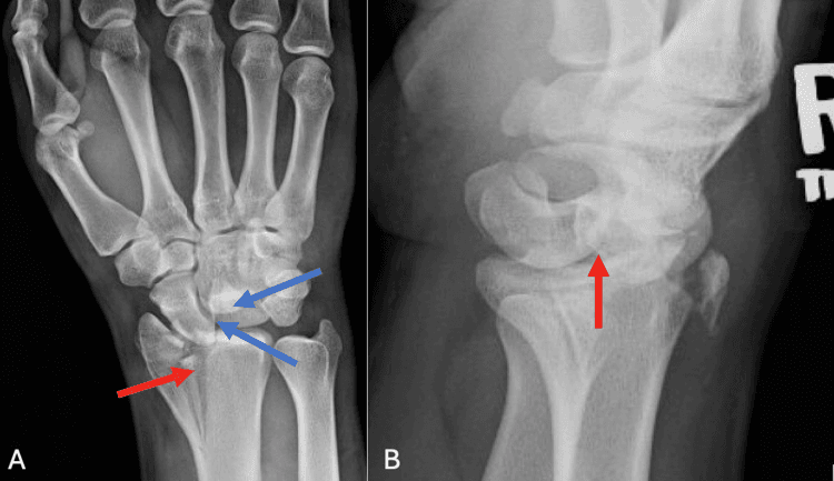 Posteroanterior and lateral wrist radiographs showing a dorsal perilunate dislocation associated with a comminuted distal radius fracture