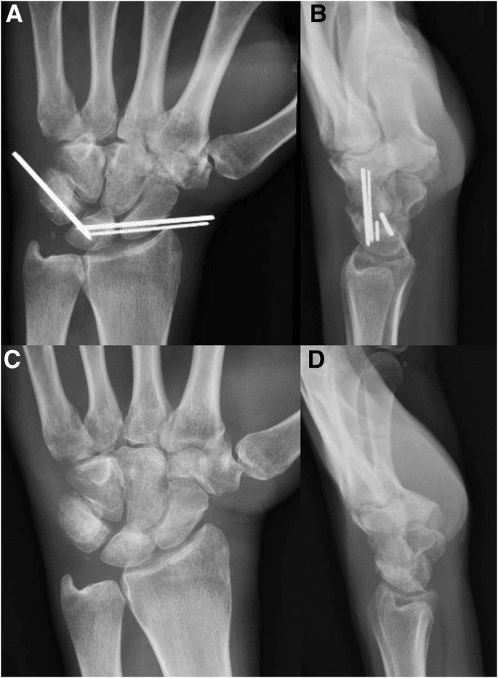 Serial postoperative posteroanterior and lateral wrist radiographs showing K-wire fixation and maintained carpal alignment after wire removal