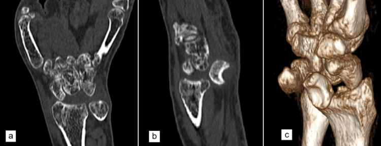 Coronal sagittal and three-dimensional CT showing absence of the lunate from the proximal carpal row and displacement into the carpal tunnel