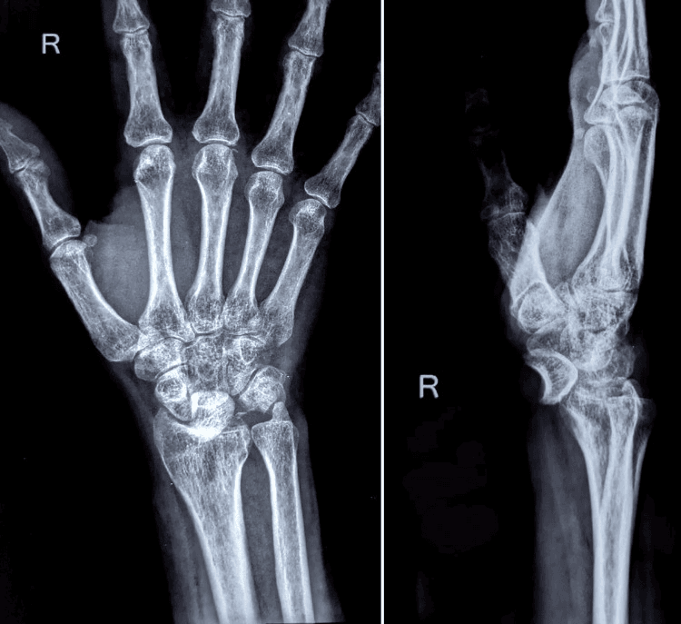 Posteroanterior and lateral wrist radiographs showing a neglected volar lunate dislocation with carpal degeneration