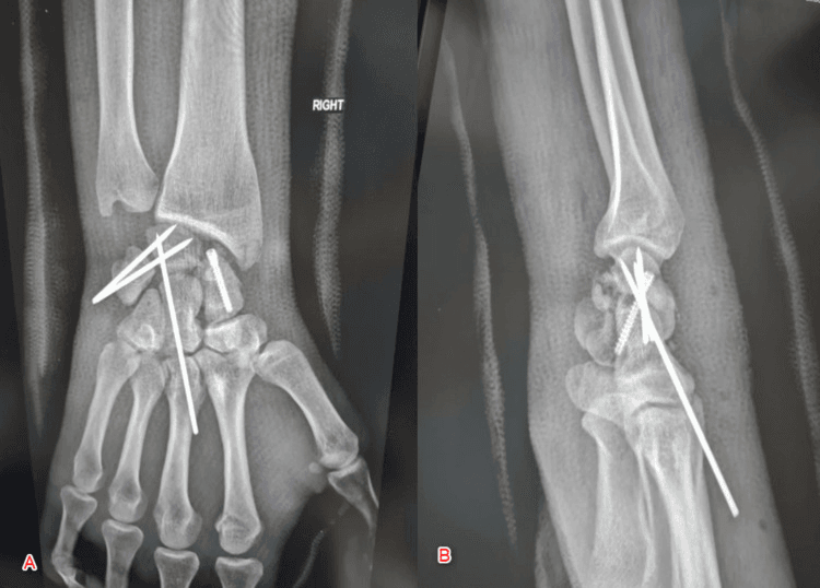 Postoperative posteroanterior and lateral radiographs showing Herbert screw and K-wire fixation after palmar trans-scaphoid perilunate dislocation