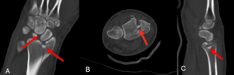 Coronal axial and sagittal CT after closed reduction showing residual scapholunate diastasis and distal-radius comminution