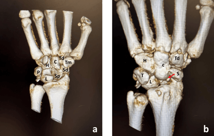 Three-dimensional CT reconstructions showing a trans-scaphoid perilunate fracture-dislocation