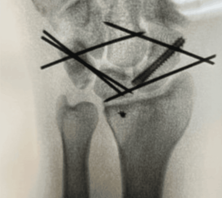 Posteroanterior fluoroscopic image showing scaphoid screw fixation and temporary intercarpal K-wires