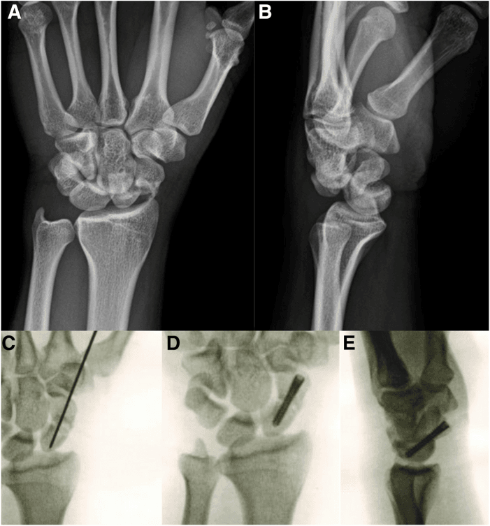 Radiographs and fluoroscopic images showing a trans-scaphoid perilunate injury before and during reduction and fixation
