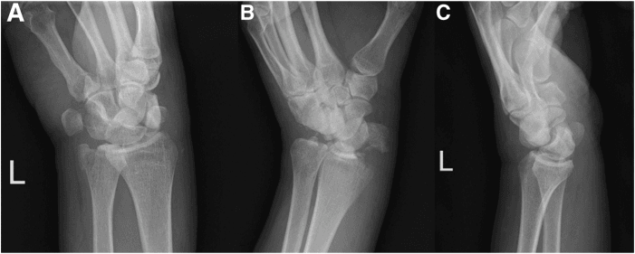 Posteroanterior oblique and lateral radiographs showing a trans-radial and trans-ulnar-styloid perilunate injury