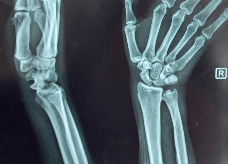 Posteroanterior and lateral wrist radiographs showing disruption of Gilula's arcs and a volarly rotated lunate
