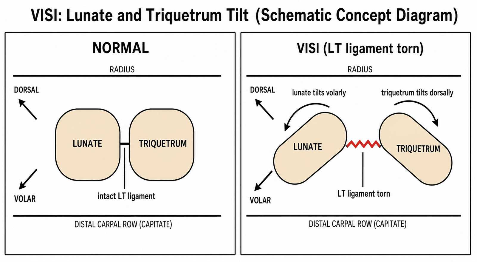 Schematic showing the lunate tilting volarly and the triquetrum tilting dorsally when the LT ligament is torn