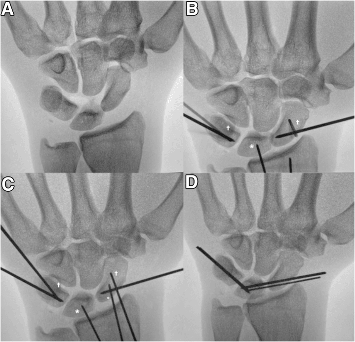 Fluoroscopic images in four panels: the carpus before wiring (A) and with K-wires placed across the carpus (B to D) after reduction of acute lunotriquetral incongruity
